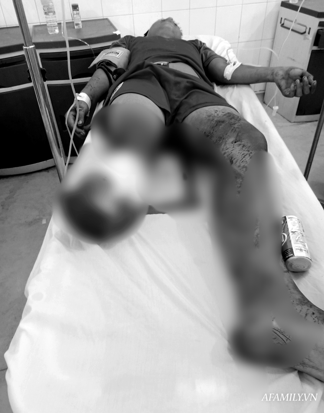 Kinh hoàng: Thiếu niên 15 tuổi bị chém đứt lìa chân phải, người nhà ướp đá đưa vào bệnh viện - Ảnh 2.