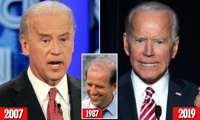 76 tuổi vẫn phong độ lịch lãm, ông Joe Biden để lộ bằng chứng nhiều lần phẫu thuật để &quot;níu kéo tuổi xuân&quot; từ cấy tóc, căng da đến cắt mí - Ảnh 7.