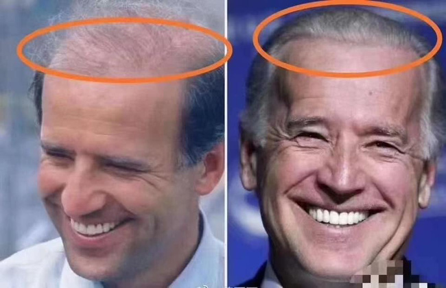 76 tuổi vẫn phong độ lịch lãm, ông Joe Biden để lộ bằng chứng nhiều lần phẫu thuật để &quot;níu kéo tuổi xuân&quot; từ cấy tóc, căng da đến cắt mí - Ảnh 3.